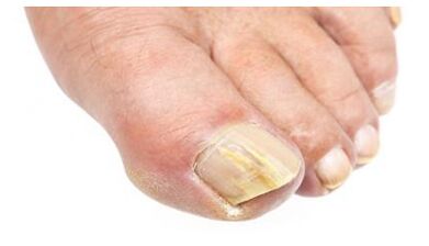 Mycosis of the foot and nail