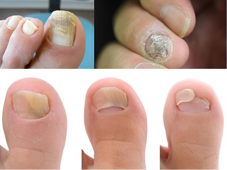 Stage of onychomycosis